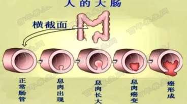 大肠癌早发现、早诊治