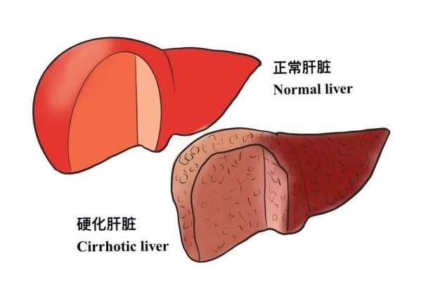 【科普】肝纤维化是什么？是否可以逆转？