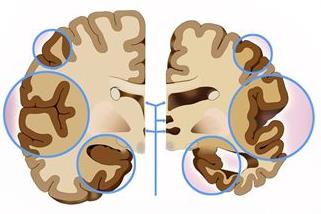 什么是脑萎缩？造成脑萎缩的原因有哪些？