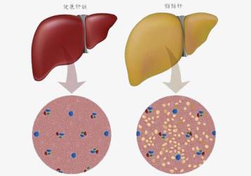 轻度脂肪肝没在意，4年后肝硬化中晚期！脂肪肝到肝癌只要4步！
