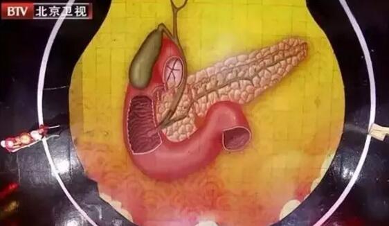 胰腺囊肿是怎么回事图片